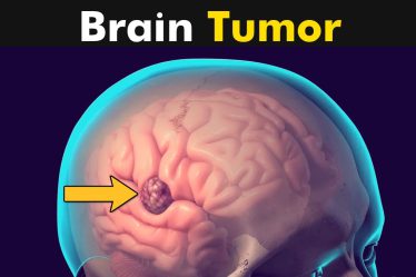 मस्तिष्क में ट्यूमर (Brain Tumour)