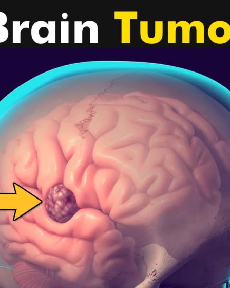 मस्तिष्क में ट्यूमर (Brain Tumour)