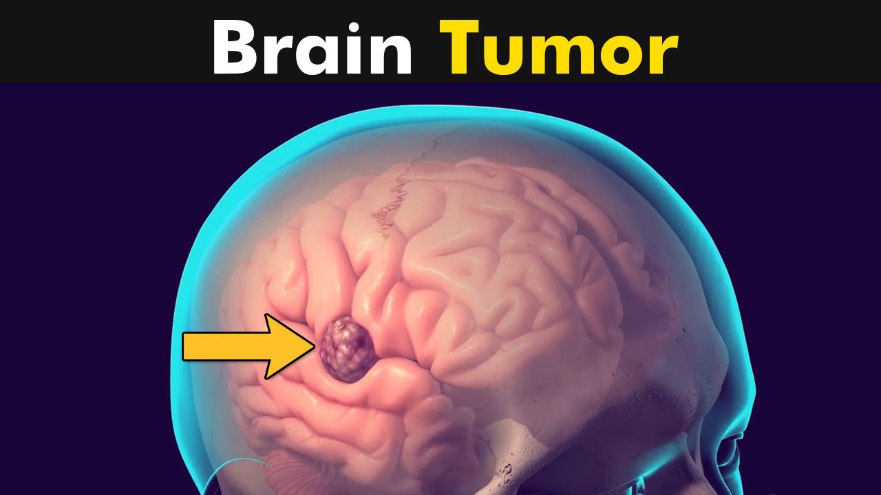 मस्तिष्क में ट्यूमर (Brain Tumour)